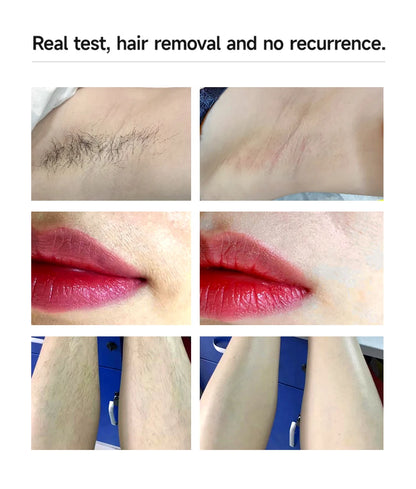 Viral Vault™ Laser Hair Removal Machine